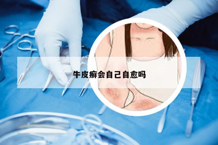 牛皮癣会自己自愈吗