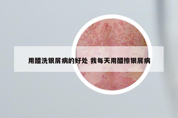 用醋洗银屑病的好处 我每天用醋擦银屑病