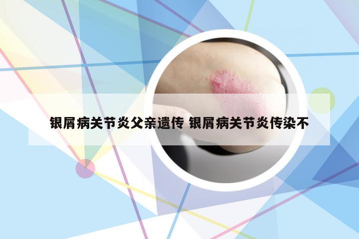 银屑病关节炎父亲遗传 银屑病关节炎传染不