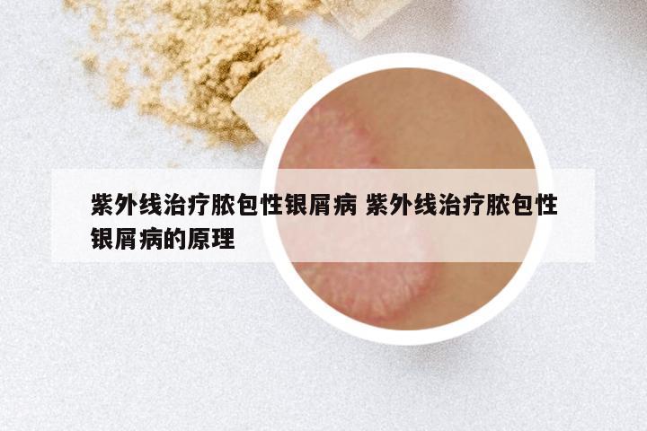 紫外线治疗脓包性银屑病 紫外线治疗脓包性银屑病的原理