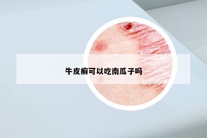 牛皮癣可以吃南瓜子吗