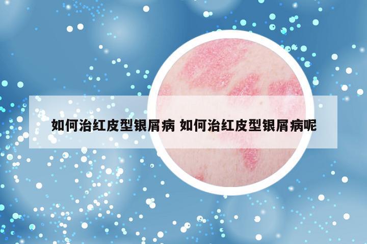 如何治红皮型银屑病 如何治红皮型银屑病呢