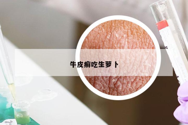牛皮癣吃生萝卜