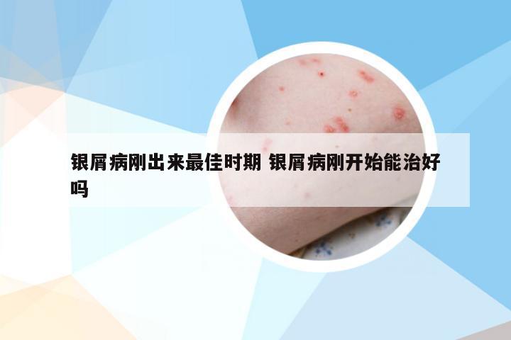 银屑病刚出来最佳时期 银屑病刚开始能治好吗