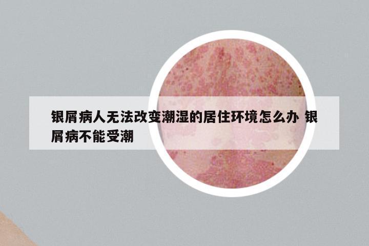 银屑病人无法改变潮湿的居住环境怎么办 银屑病不能受潮