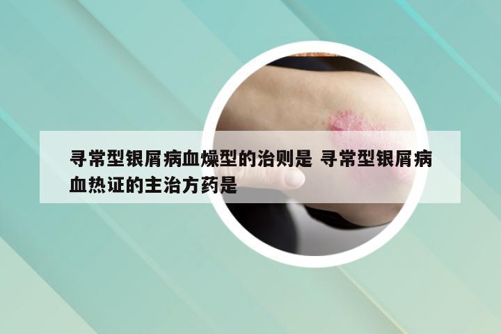 寻常型银屑病血燥型的治则是 寻常型银屑病血热证的主治方药是