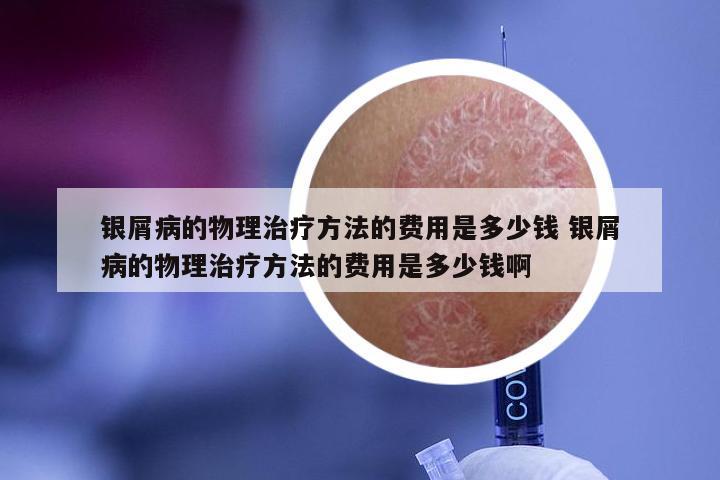 银屑病的物理治疗方法的费用是多少钱 银屑病的物理治疗方法的费用是多少钱啊
