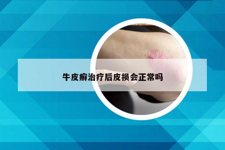 牛皮癣治疗后皮损会正常吗