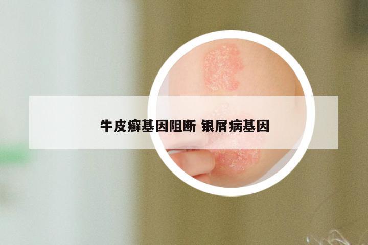 牛皮癣基因阻断 银屑病基因