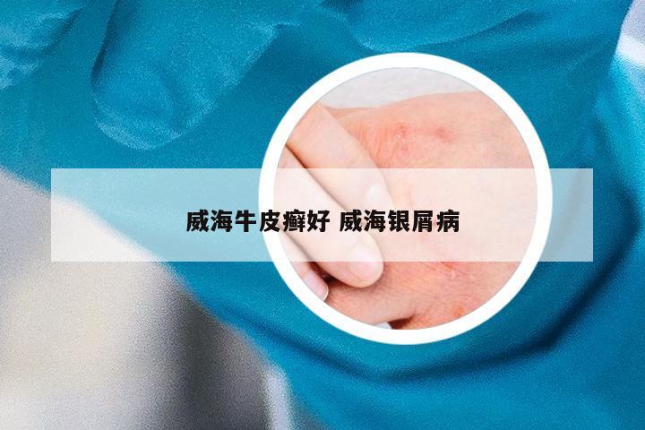 威海牛皮癣好 威海银屑病