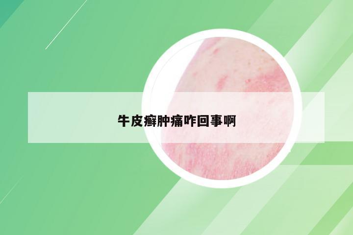 牛皮癣肿痛咋回事啊