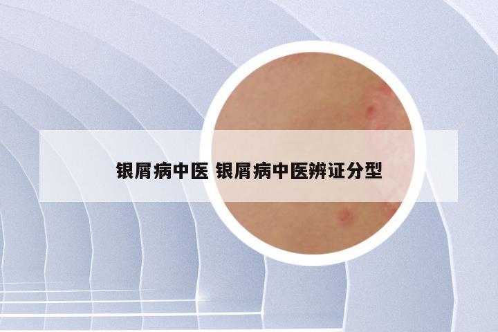 银屑病中医 银屑病中医辨证分型