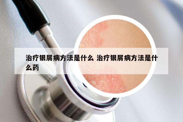 治疗银屑病方法是什么 治疗银屑病方法是什么药
