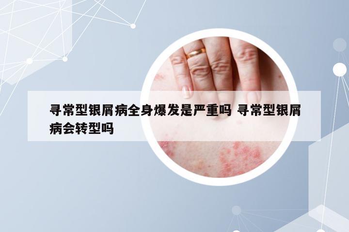 寻常型银屑病全身爆发是严重吗 寻常型银屑病会转型吗