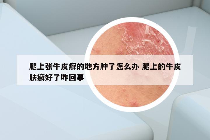 腿上张牛皮癣的地方肿了怎么办 腿上的牛皮肤癣好了咋回事