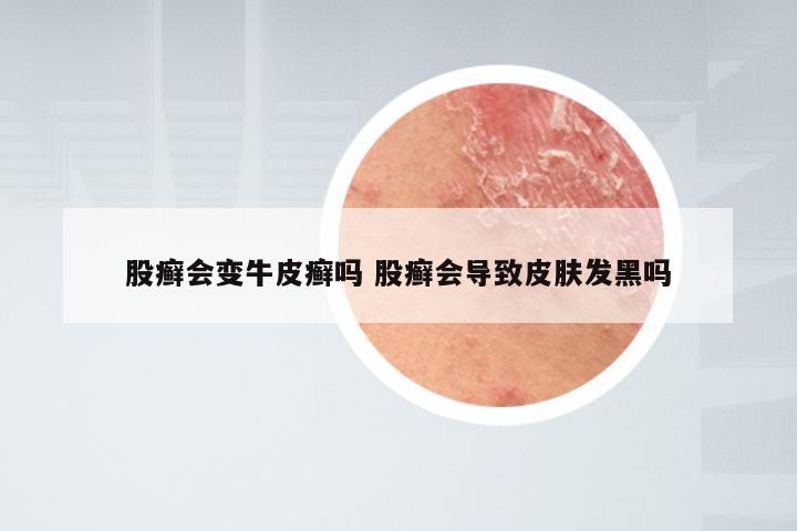 股癣会变牛皮癣吗 股癣会导致皮肤发黑吗