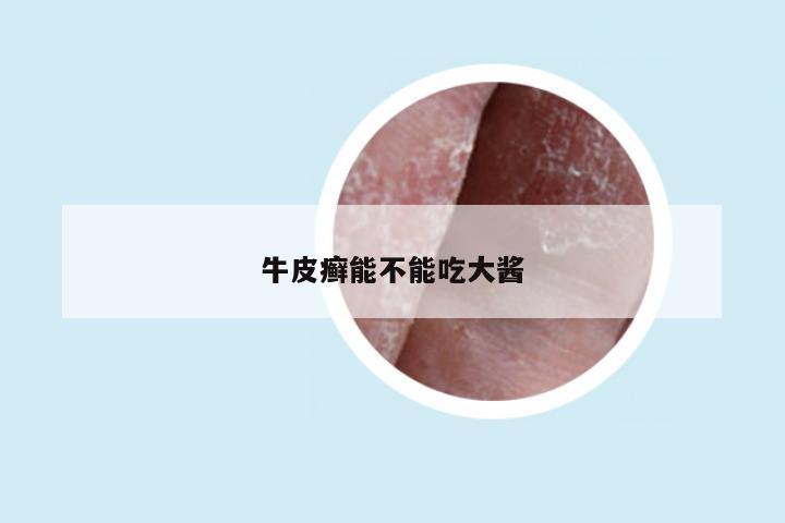 牛皮癣能不能吃大酱