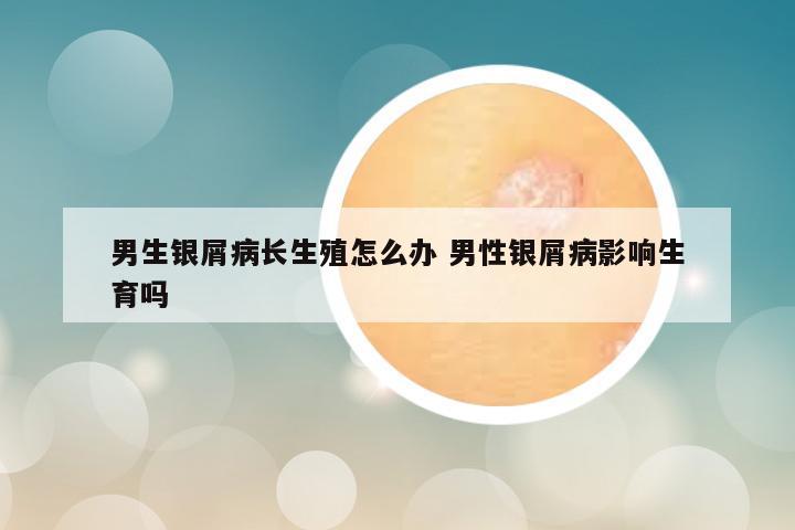 男生银屑病长生殖怎么办 男性银屑病影响生育吗