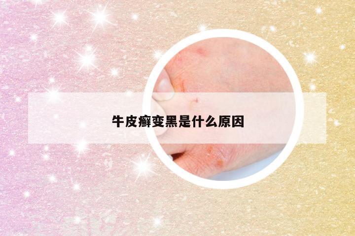 牛皮癣变黑是什么原因
