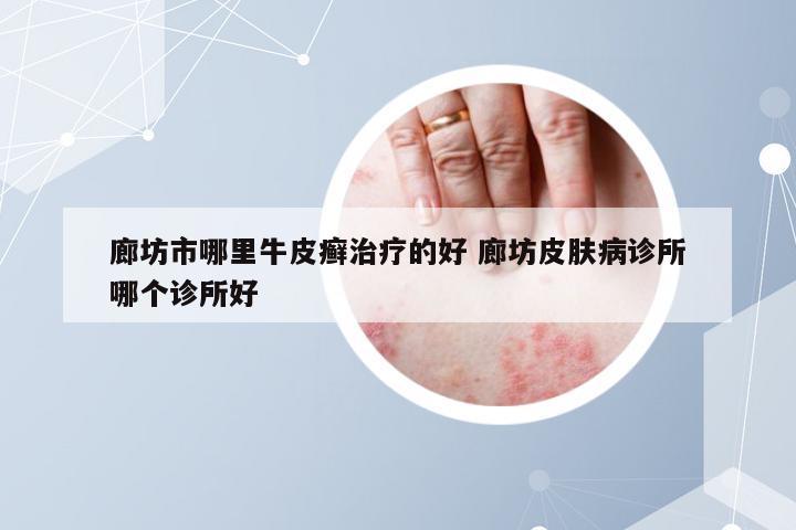 廊坊市哪里牛皮癣治疗的好 廊坊皮肤病诊所哪个诊所好