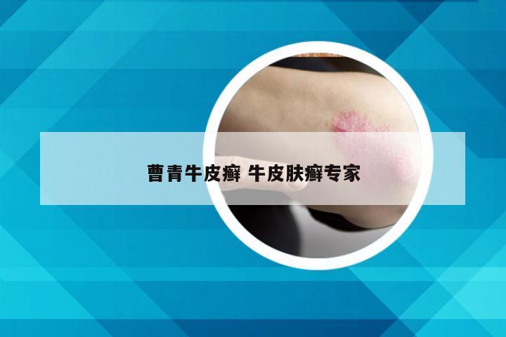 曹青牛皮癣 牛皮肤癣专家