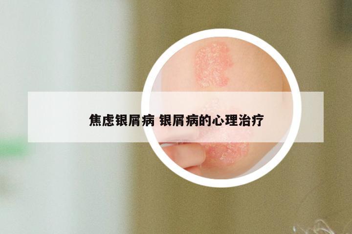 焦虑银屑病 银屑病的心理治疗