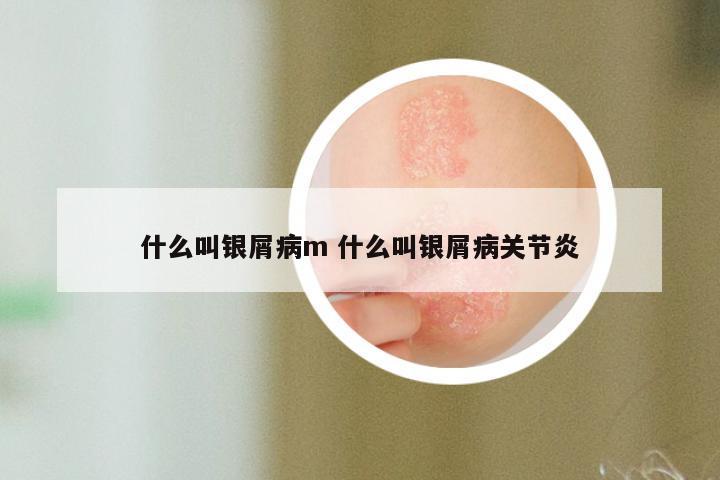 什么叫银屑病m 什么叫银屑病关节炎
