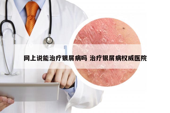 网上说能治疗银屑病吗 治疗银屑病权威医院