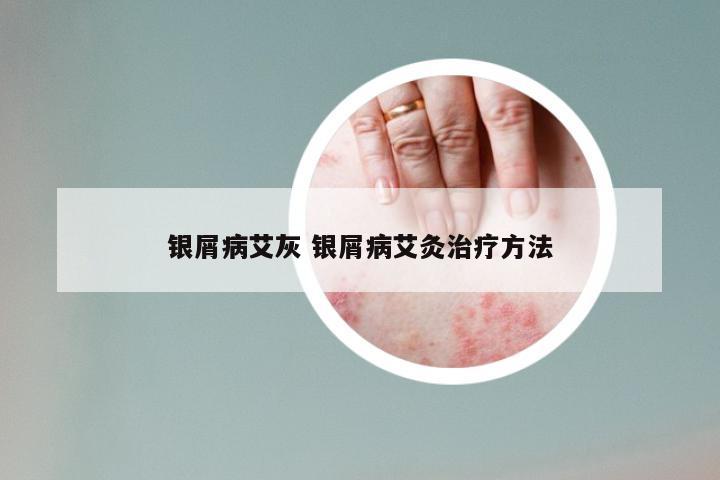 银屑病艾灰 银屑病艾灸治疗方法