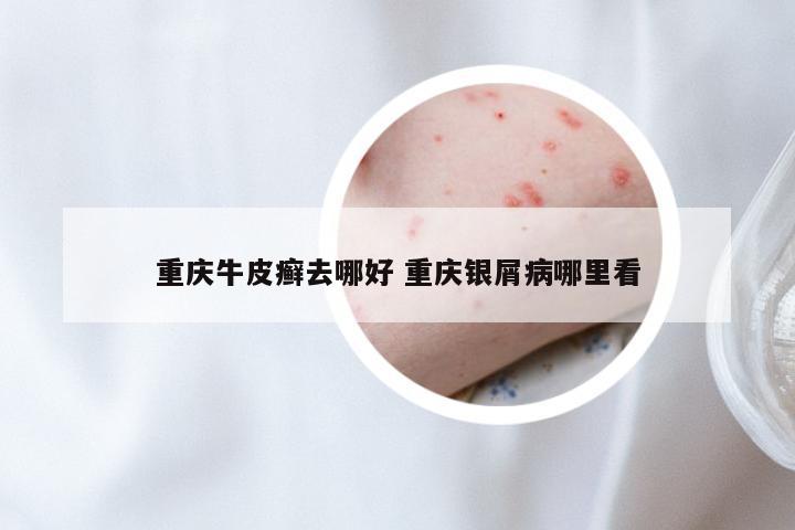 重庆牛皮癣去哪好 重庆银屑病哪里看