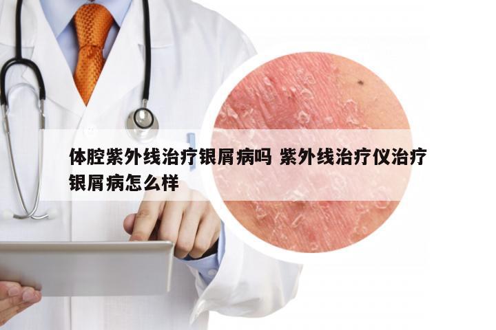 体腔紫外线治疗银屑病吗 紫外线治疗仪治疗银屑病怎么样