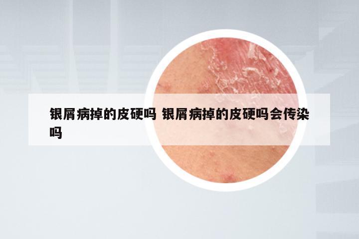 银屑病掉的皮硬吗 银屑病掉的皮硬吗会传染吗