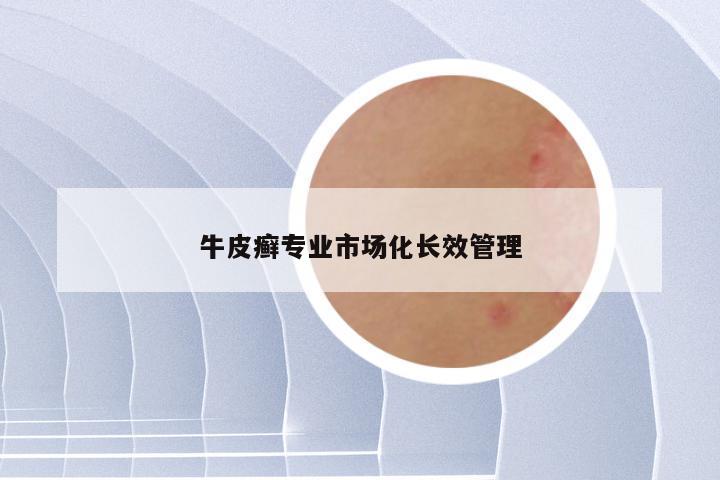 牛皮癣专业市场化长效管理