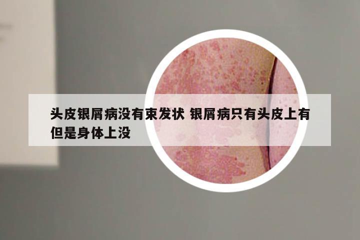 头皮银屑病没有束发状 银屑病只有头皮上有但是身体上没