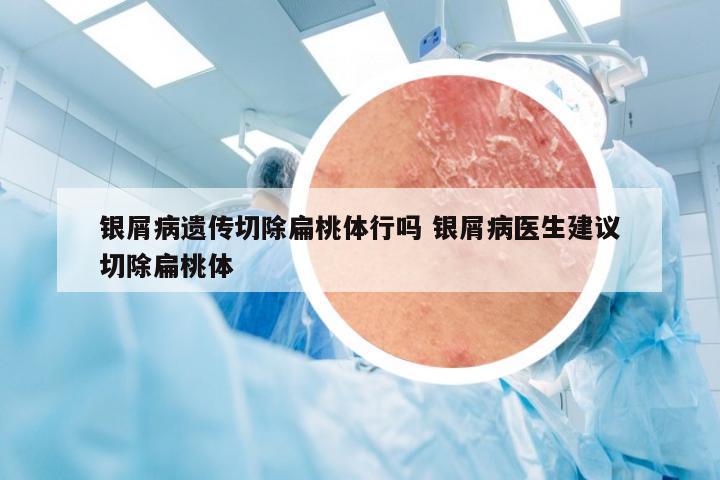 银屑病遗传切除扁桃体行吗 银屑病医生建议切除扁桃体