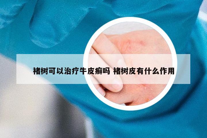 褚树可以治疗牛皮癣吗 褚树皮有什么作用