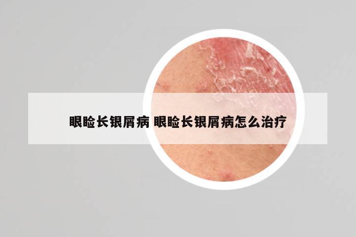 眼睑长银屑病 眼睑长银屑病怎么治疗