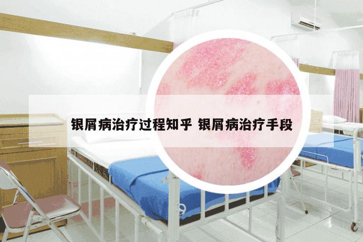 银屑病治疗过程知乎 银屑病治疗手段
