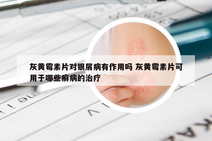 灰黄霉素片对银屑病有作用吗 灰黄霉素片可用于哪些癣病的治疗