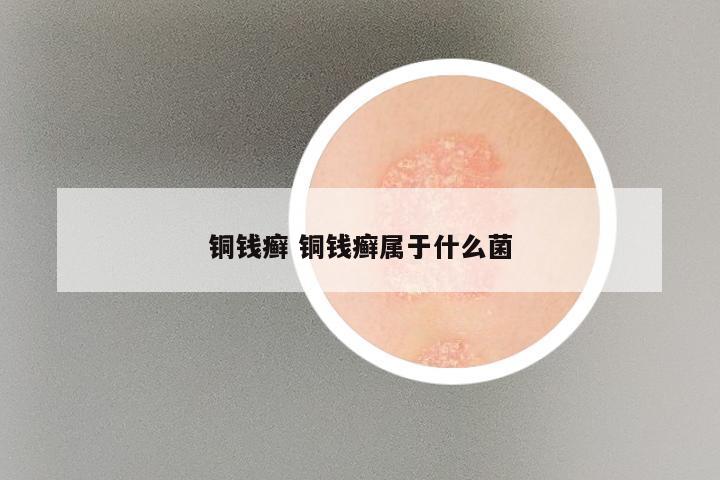 铜钱癣 铜钱癣属于什么菌