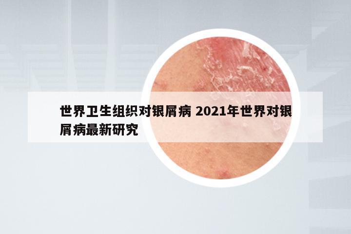 世界卫生组织对银屑病 2021年世界对银屑病最新研究