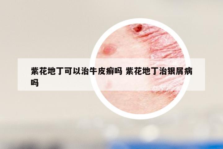 紫花地丁可以治牛皮癣吗 紫花地丁治银屑病吗