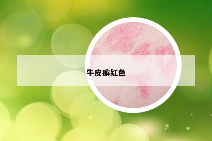 牛皮癣红色