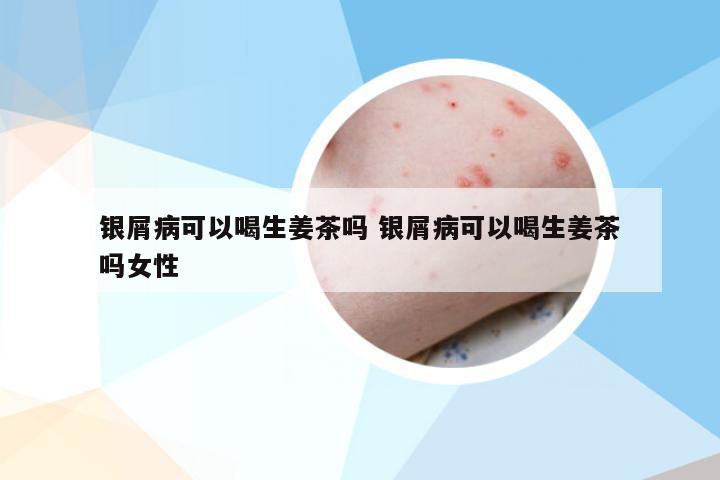 银屑病可以喝生姜茶吗 银屑病可以喝生姜茶吗女性