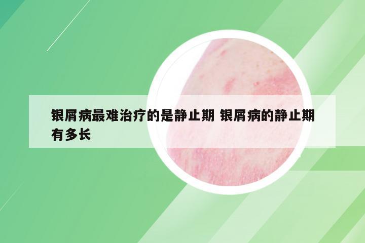 银屑病最难治疗的是静止期 银屑病的静止期有多长