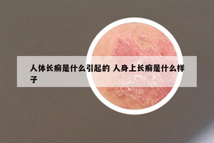 人体长癣是什么引起的 人身上长癣是什么样子