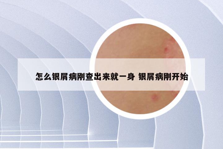 怎么银屑病刚查出来就一身 银屑病刚开始