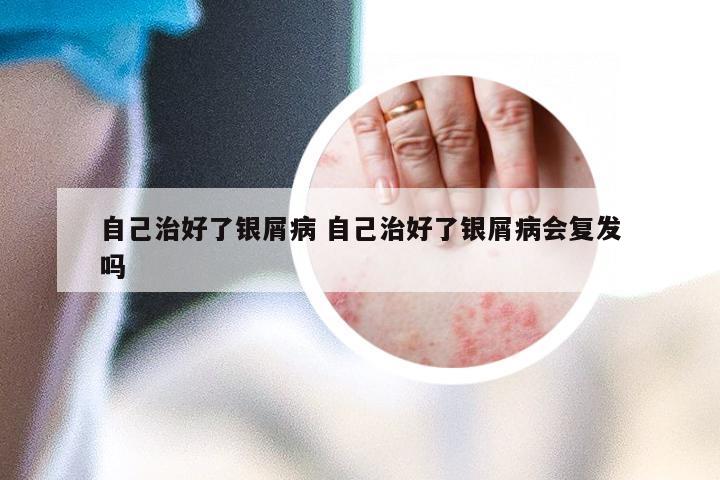 自己治好了银屑病 自己治好了银屑病会复发吗
