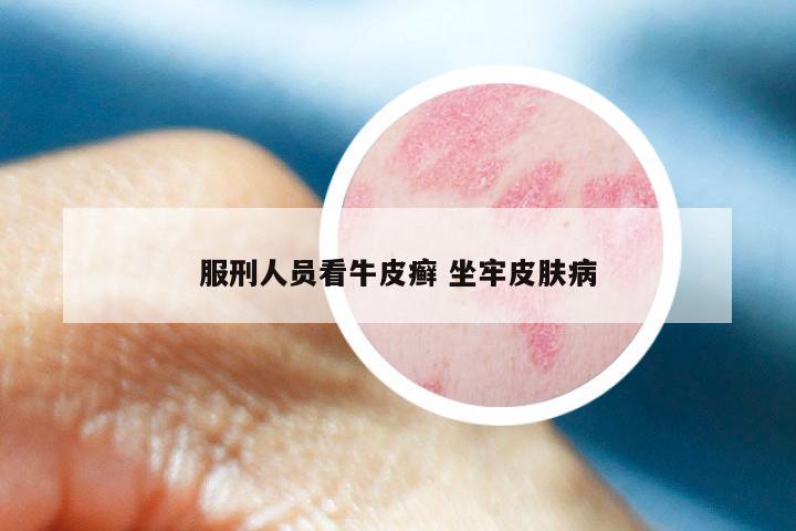 服刑人员看牛皮癣 坐牢皮肤病