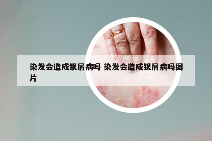 染发会造成银屑病吗 染发会造成银屑病吗图片